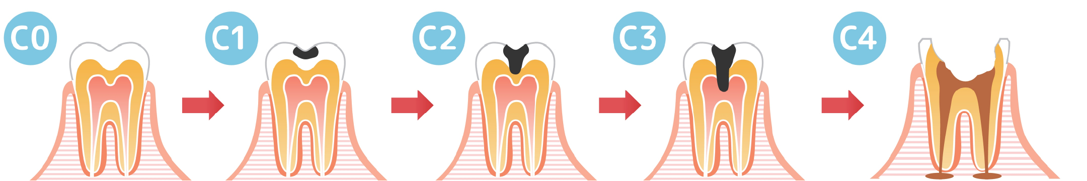 虫歯の進行